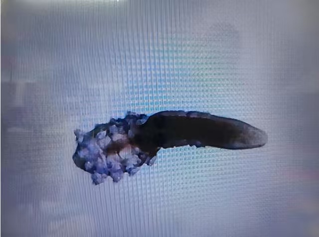 4岁男童眼睛痒，家长以为只是结膜炎，检查发现睫毛有数十只小虫，医生提醒→