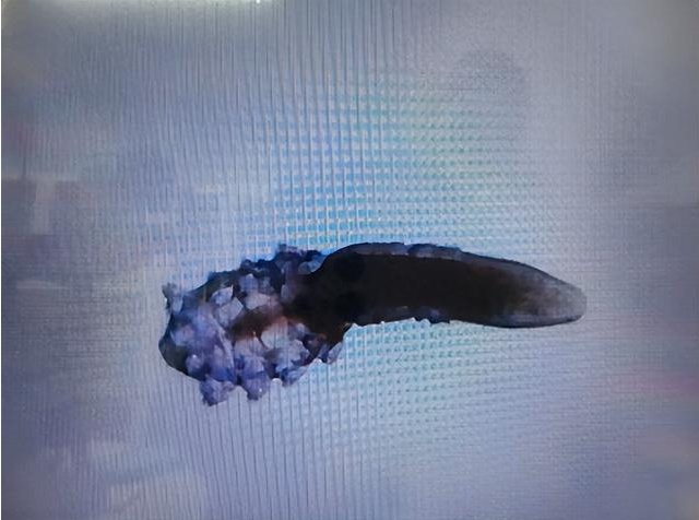 头皮发麻!上海4岁男孩睫毛上竟挂满"小螃蟹",还在蠕动… 头皮发麻!上海4岁男孩睫毛上竟挂满"小螃蟹",还在蠕动…
