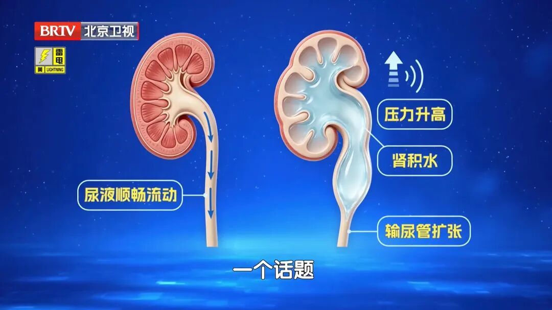 很多人都有的1个习惯,让肾结出一颗颗石头,多吃这几种食物,帮助身体顺畅代谢 很多人都有的1个习惯,让肾结出一颗颗石头,多吃这几种食物,帮助身体顺畅代谢