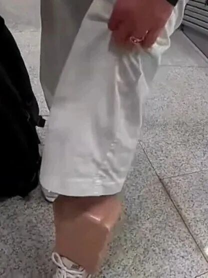 女子小腿呈长方形状,海关:已立案 女子小腿呈长方形状,海关:已立案
