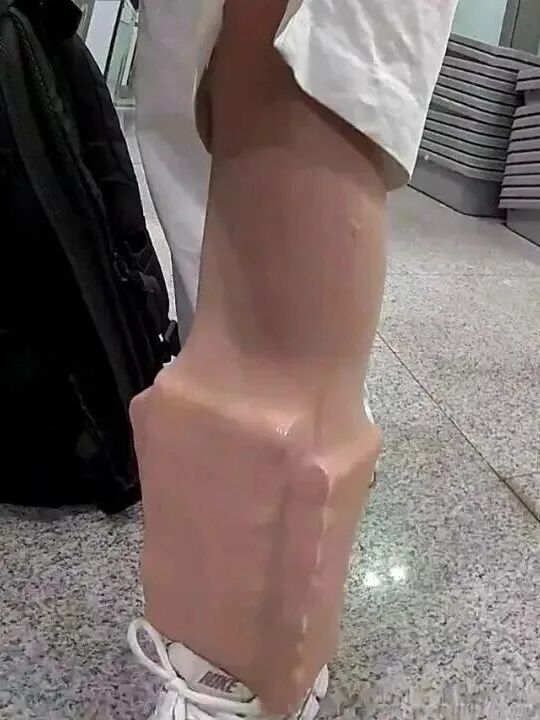 女子小腿呈长方形状,海关:已立案 女子小腿呈长方形状,海关:已立案
