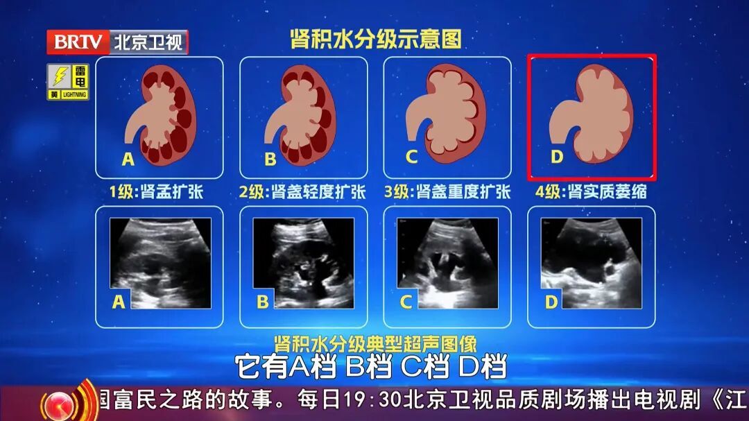 很多人都有的1个习惯,让肾结出一颗颗石头,多吃这几种食物,帮助身体顺畅代谢 很多人都有的1个习惯,让肾结出一颗颗石头,多吃这几种食物,帮助身体顺畅代谢