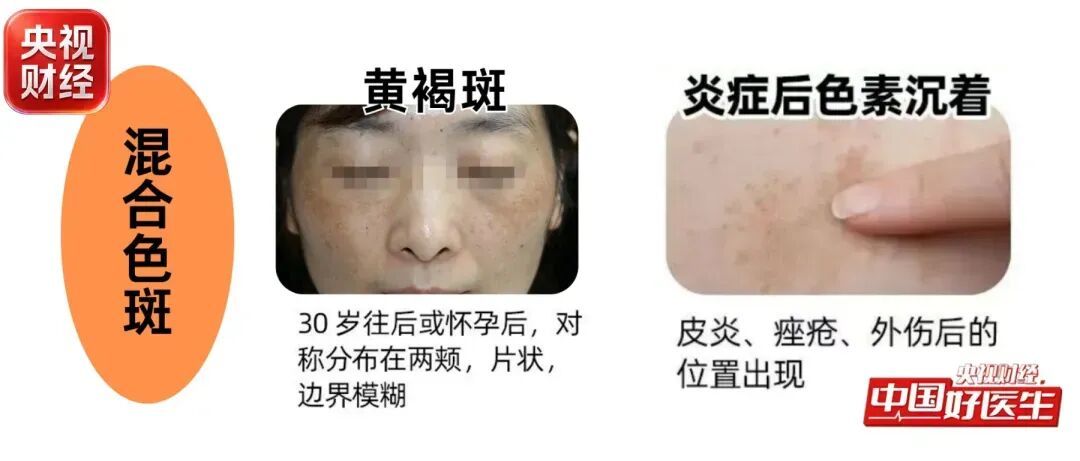 才30岁就长“老年斑”?网红祛斑偏方,暗藏风险!!! 才30岁就长“老年斑”?网红祛斑偏方,暗藏风险!!!
