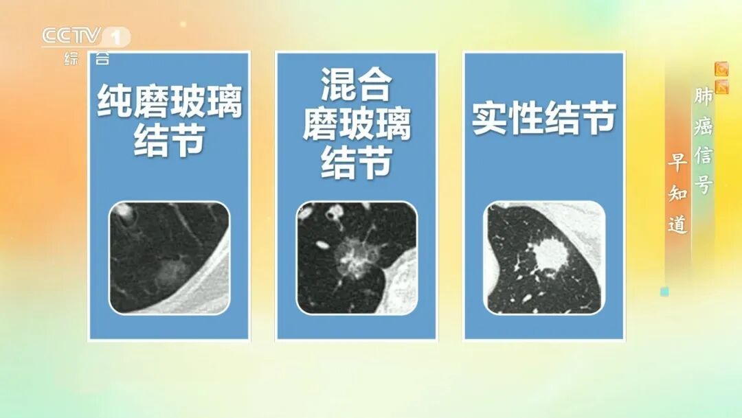 体检查出肺结节,会发展成肺癌吗?出现这些特征要警惕 体检查出肺结节,会发展成肺癌吗?出现这些特征要警惕