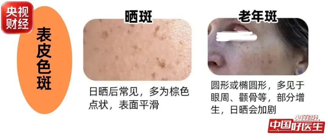 才30岁就长“老年斑”?网红祛斑偏方,暗藏风险!!! 才30岁就长“老年斑”?网红祛斑偏方,暗藏风险!!!