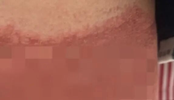 多名孩子的隐私部位出现红肿、脱皮,灼烧痕迹就像被烫过一样!医生紧急提醒 多名孩子的隐私部位出现红肿、脱皮,灼烧痕迹就像被烫过一样!医生紧急提醒