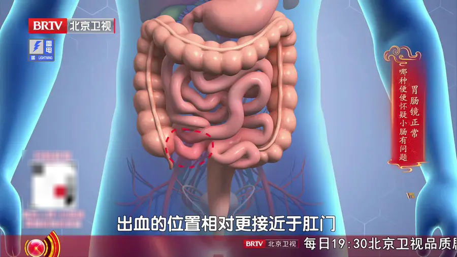 这种大便颜色，真的很危险，不是痔疮，身体出现3个变化，抓紧去医院