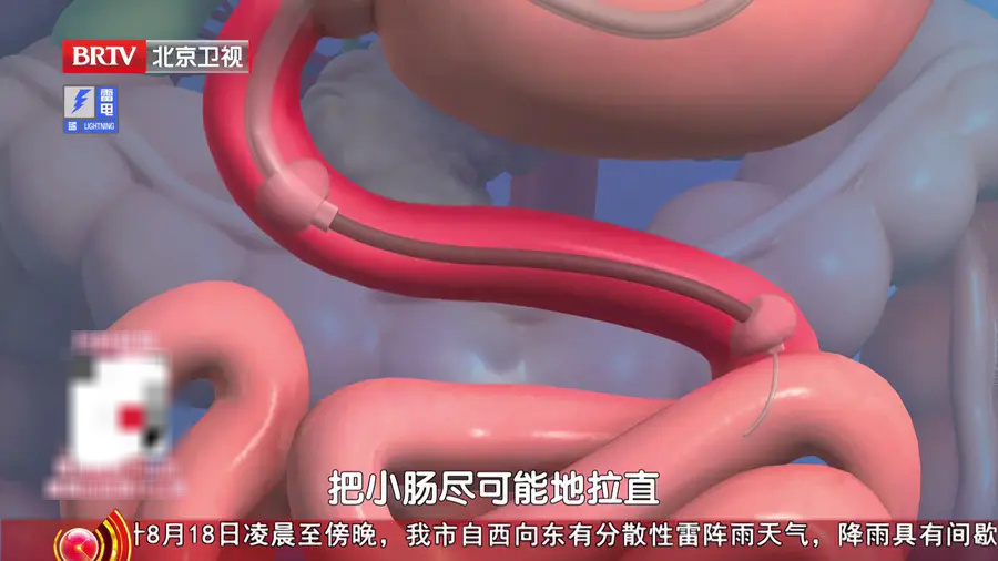 这种大便颜色，真的很危险，不是痔疮，身体出现3个变化，抓紧去医院