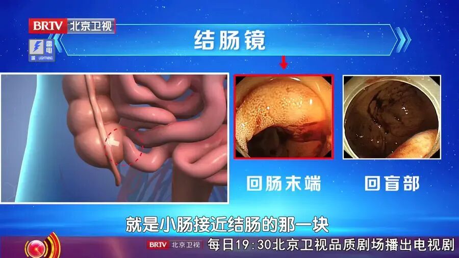 这种大便颜色，真的很危险，不是痔疮，身体出现3个变化，抓紧去医院
