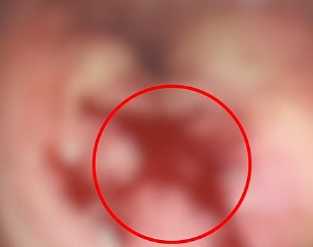 男子确诊癌症晚期,已无法手术!44岁弟弟同时确诊,术后一周便出院;区别在哪? 男子确诊癌症晚期,已无法手术!44岁弟弟同时确诊,术后一周便出院;区别在哪?