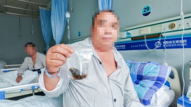 54岁男子胆囊取出罕见7公分“牛油果”!三餐虽然规律,却因无肉不欢、重油重盐中招 54岁男子胆囊取出罕见7公分“牛油果”!三餐虽然规律,却因无肉不欢、重油重盐中招