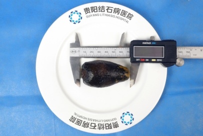 54岁男子胆囊取出罕见7公分“牛油果”!三餐虽然规律,却因无肉不欢、重油重盐中招 54岁男子胆囊取出罕见7公分“牛油果”!三餐虽然规律,却因无肉不欢、重油重盐中招