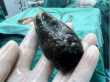 54岁男子胆囊取出罕见7公分“牛油果”!三餐虽然规律,却因无肉不欢、重油重盐中招 54岁男子胆囊取出罕见7公分“牛油果”!三餐虽然规律,却因无肉不欢、重油重盐中招
