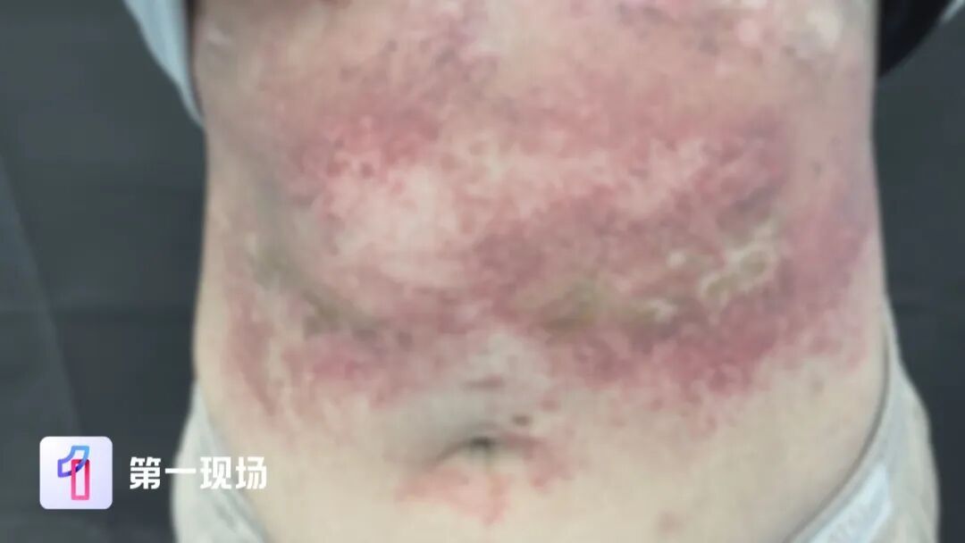 洗衣液+消毒液混合洗衣，女子皮肤表层像“羊皮纸”般脱落！医生提醒→