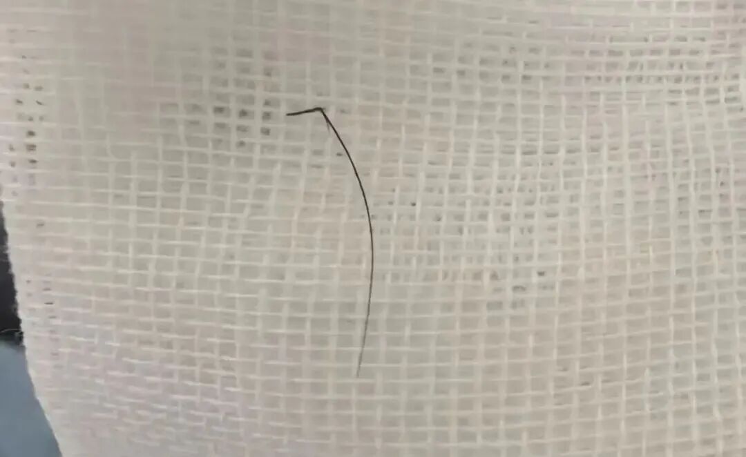 耳朵痒了好几天，里面竟“长出一圈羽毛”？29岁姑娘的经历，给爱采耳的人提了个醒