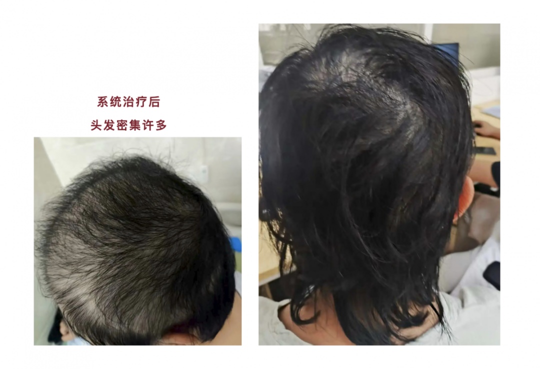 两名未成年少女出现大面积脱发，家长到处求医 医生找到病因：孩子为“解压”自己拔的