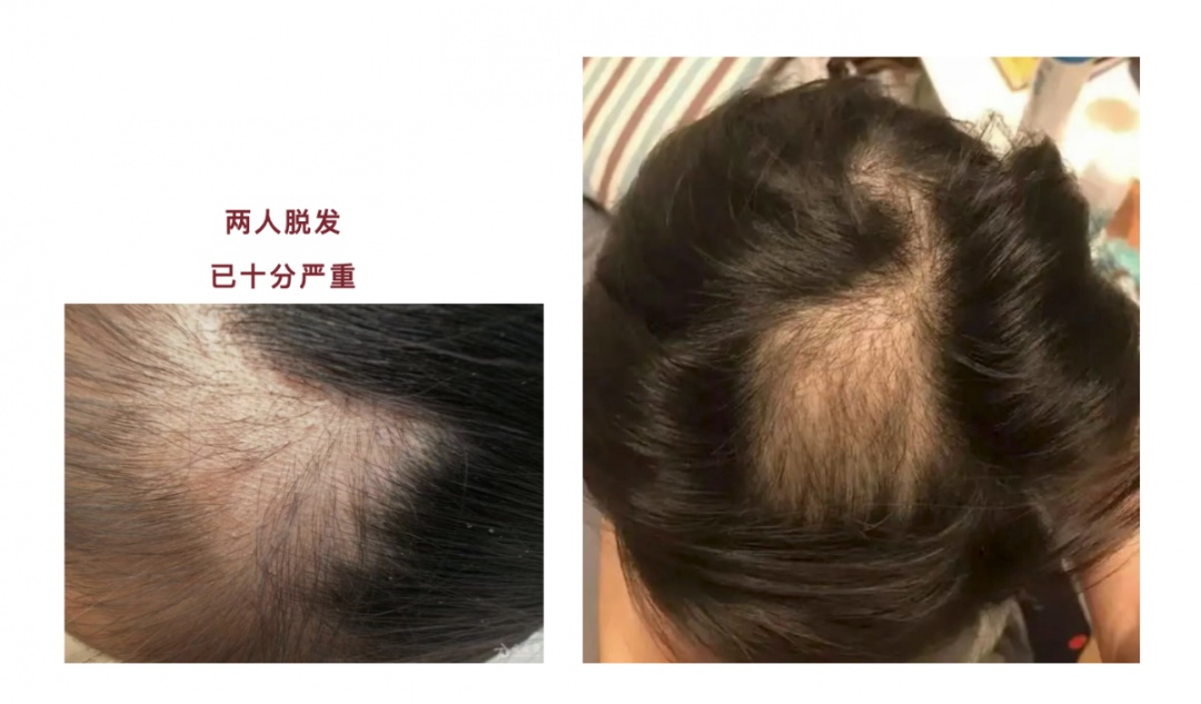 两名未成年少女出现大面积脱发，家长到处求医 医生找到病因：孩子为“解压”自己拔的