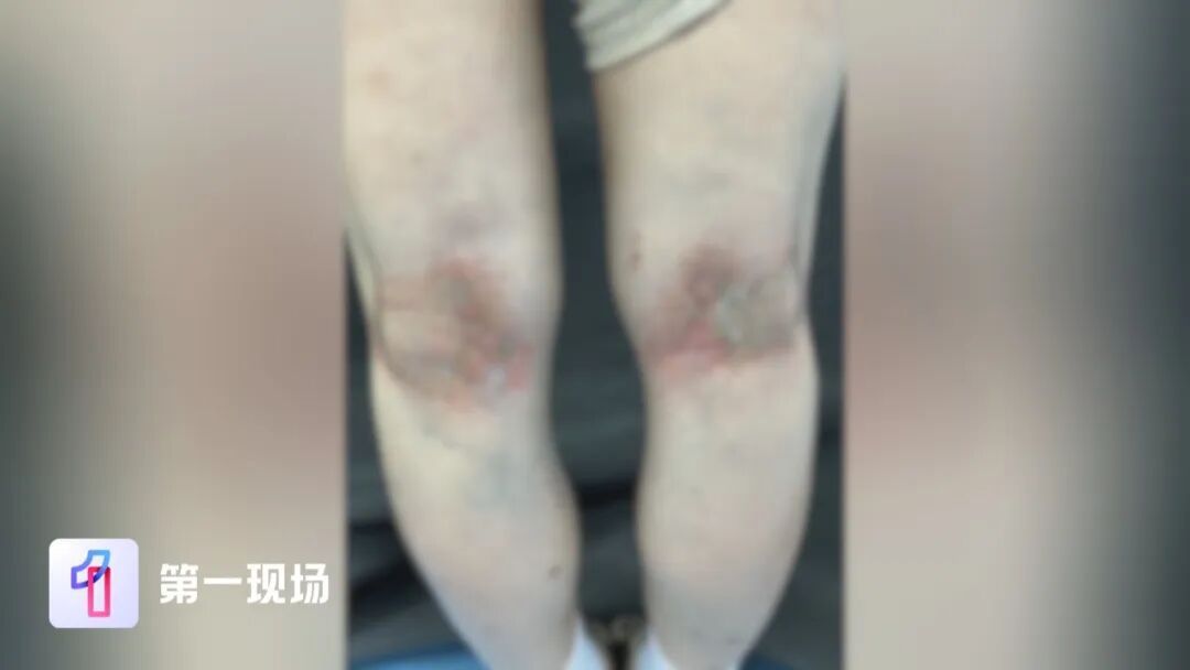 洗衣液+消毒液混合洗衣，女子皮肤表层像“羊皮纸”般脱落！医生提醒→
