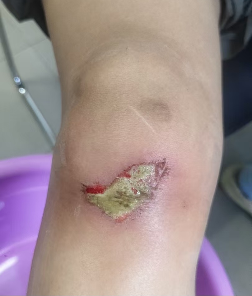 杭州35岁女子环洱海骑行时摔破皮,用自来水冲了冲伤口,回家后高烧近40℃,紧急送医 杭州35岁女子环洱海骑行时摔破皮,用自来水冲了冲伤口,回家后高烧近40℃,紧急送医