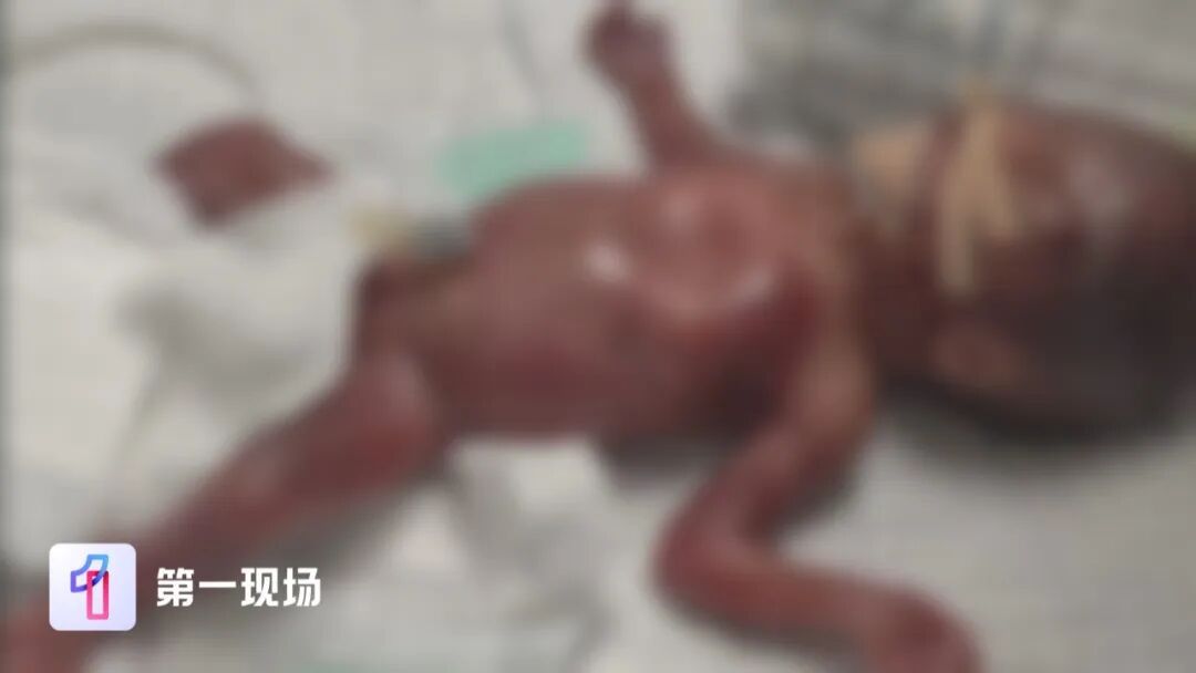 “我舍不得!”二胎妈妈含泪拒绝放弃,530克超早产儿经历重重生死关,终于回家 “我舍不得!”二胎妈妈含泪拒绝放弃,530克超早产儿经历重重生死关,终于回家