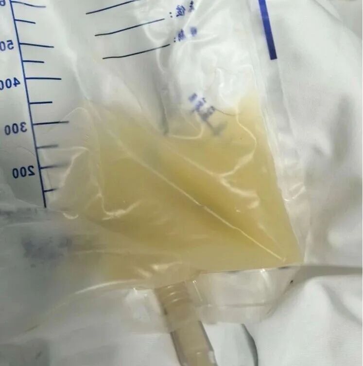 独居老人差点失去一个肾,竟是因为一根支架—— 独居老人差点失去一个肾,竟是因为一根支架——