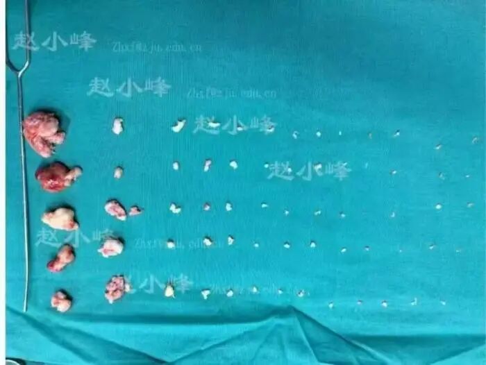 一次宫腔镜挖出68颗!这种肿瘤为何缠上育龄女性? 一次宫腔镜挖出68颗!这种肿瘤为何缠上育龄女性?