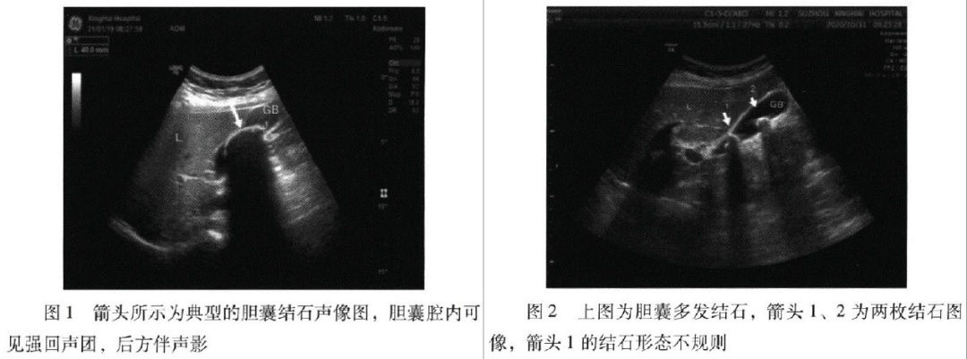 一位女士的胆囊里，竟取出270多枚“小金豆”，不疼就没事吗?