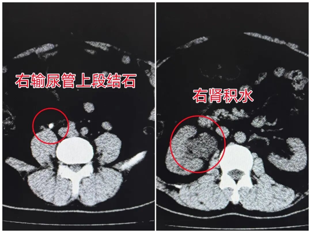 叉车司机久坐憋尿成常态，结果尿路被1.2厘米结石“堵住”