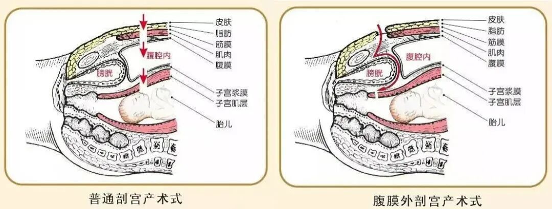 52岁产妇,还有慢性高血压,妊娠期糖尿病……这个不进入腹腔的手术让她平安当妈 52岁产妇,还有慢性高血压,妊娠期糖尿病……这个不进入腹腔的手术让她平安当妈