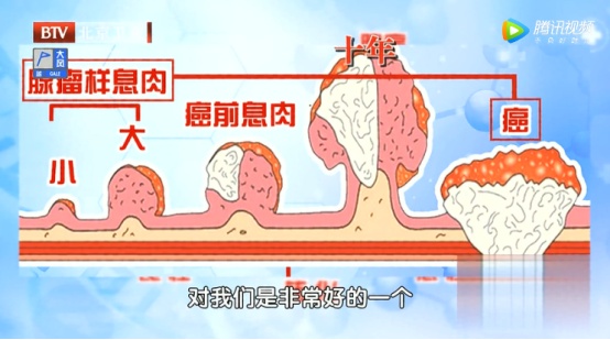 身上有这种“肉”,50岁后几乎100%癌变,有这类“外貌特征”的人风险更大…… 身上有这种“肉”,50岁后几乎100%癌变,有这类“外貌特征”的人风险更大……
