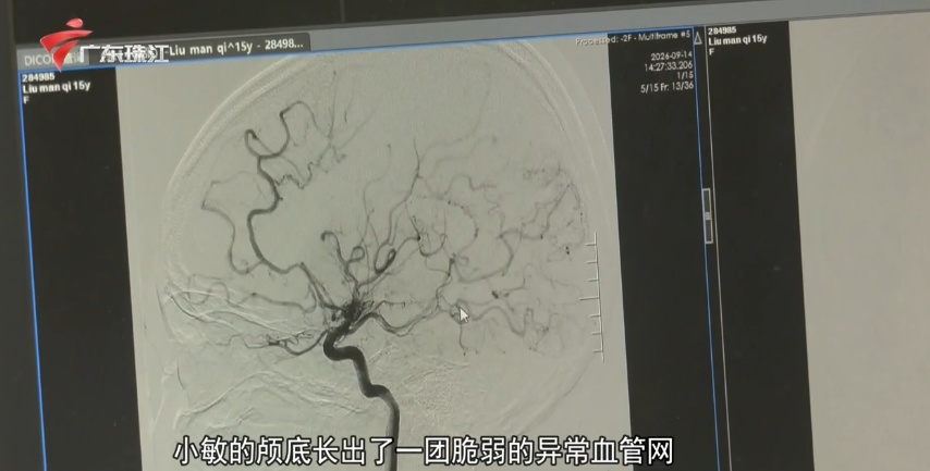 15岁女孩情绪激动后手脚发软 竟是脑中起“烟雾” 15岁女孩情绪激动后手脚发软 竟是脑中起“烟雾”
