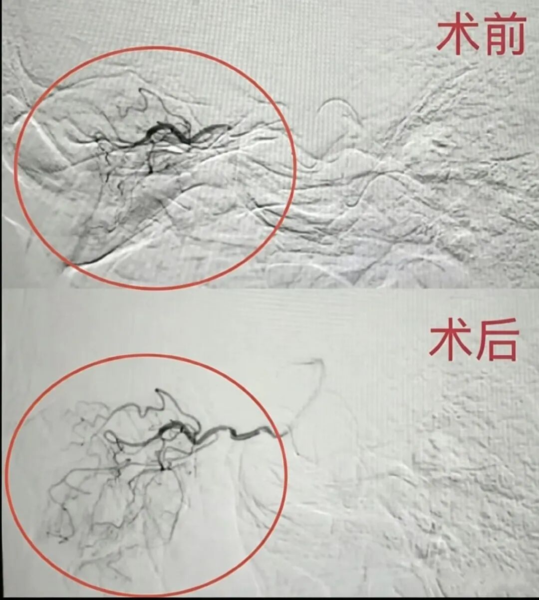 60岁阿姨熬夜刷短剧“眼中风”,险失明!医生提醒:高危人群注意这三点 60岁阿姨熬夜刷短剧“眼中风”,险失明!医生提醒:高危人群注意这三点