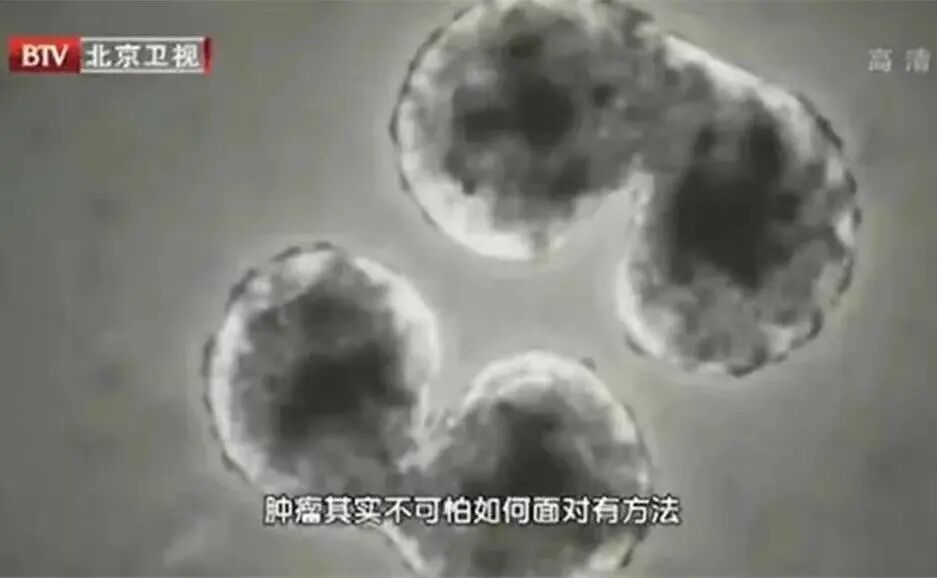 身上有这种“肉”,50岁后几乎100%癌变,有这类“外貌特征”的人风险更大…… 身上有这种“肉”,50岁后几乎100%癌变,有这类“外貌特征”的人风险更大……