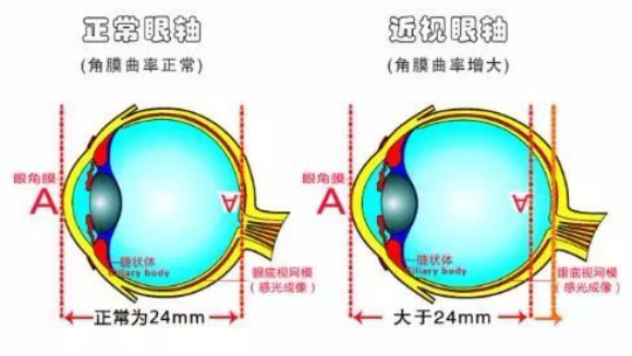 儿童青少年近视防控，“防”的到底是什么？