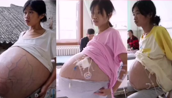 巨肚妈妈手术成功！共从她肚子里取出近80斤肿瘤和腹水