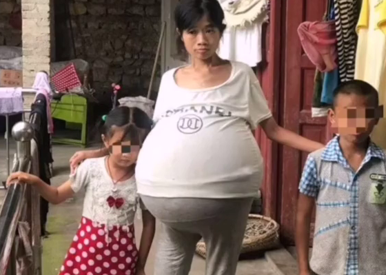 巨肚妈妈手术成功！共从她肚子里取出近80斤肿瘤和腹水