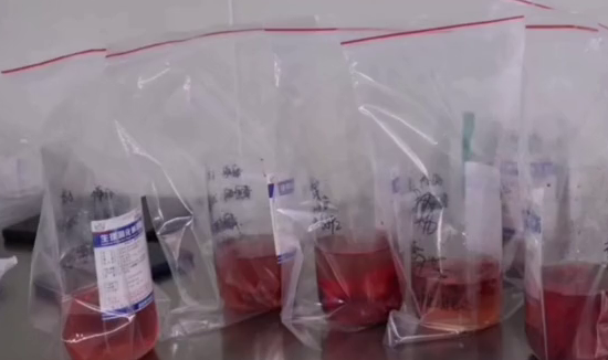 巨肚妈妈手术成功！共从她肚子里取出近80斤肿瘤和腹水