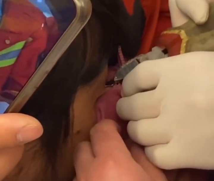 想想都疼！女子脱衣服时眼皮被拉链夹住，求助消防