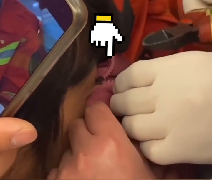 想想都疼！女子脱衣服时眼皮被拉链夹住，求助消防