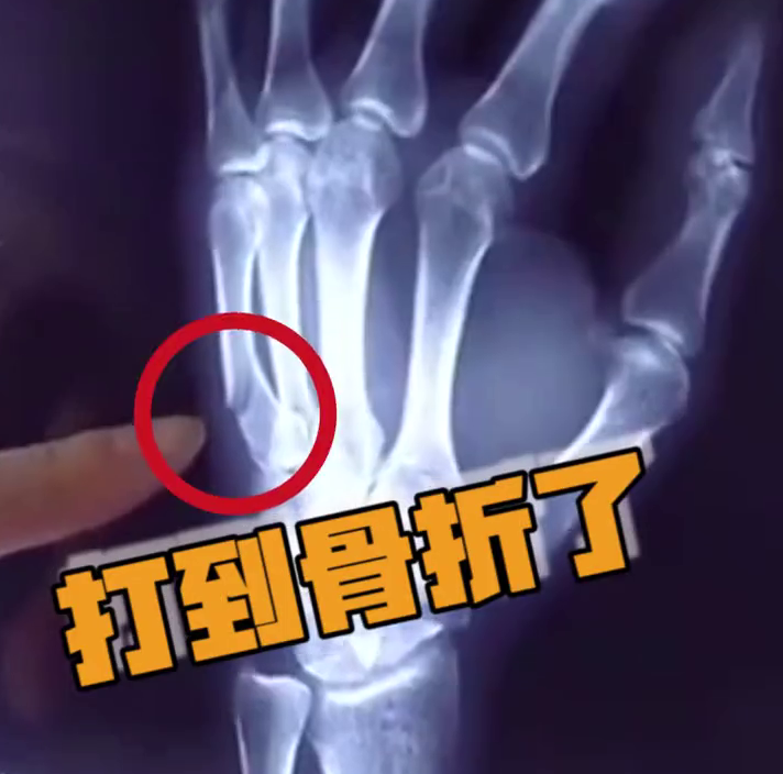 儿子做作业拖拖拉拉，男子一怒之下捶向桌子，结果手掌骨折了……