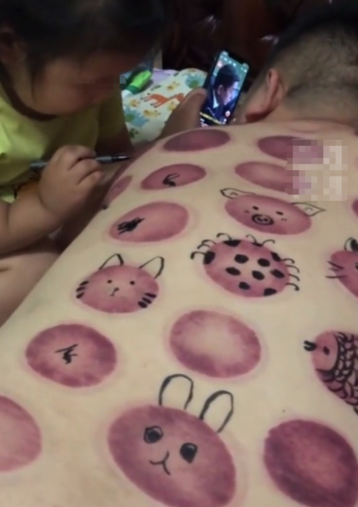 爸爸拔罐回来被女儿看到 背部被女儿画成了“动物园”