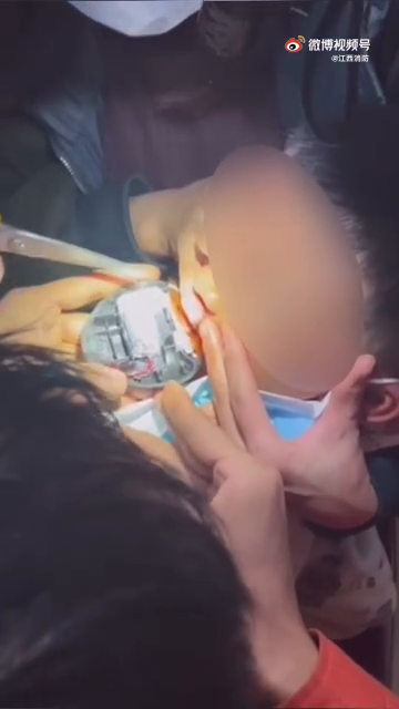 看着都痛！男孩玩电动指甲剪把舌头夹出血