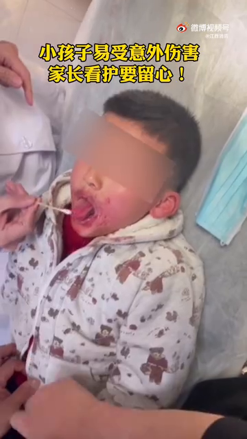 看着都痛！男孩玩电动指甲剪把舌头夹出血