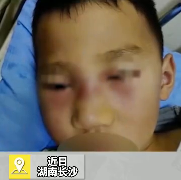 5岁男孩常挖鼻孔致反复高烧、面部红肿似奥特曼