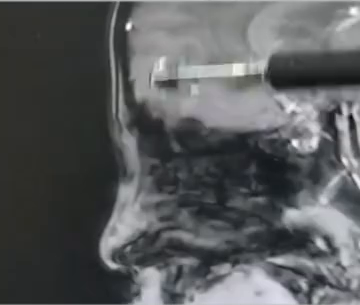 5岁男孩常挖鼻孔致反复高烧、面部红肿似奥特曼