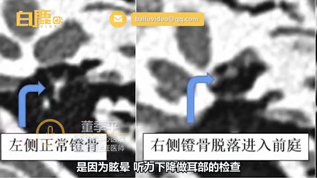 4岁儿子给妈妈掏耳朵致其眩晕一个月