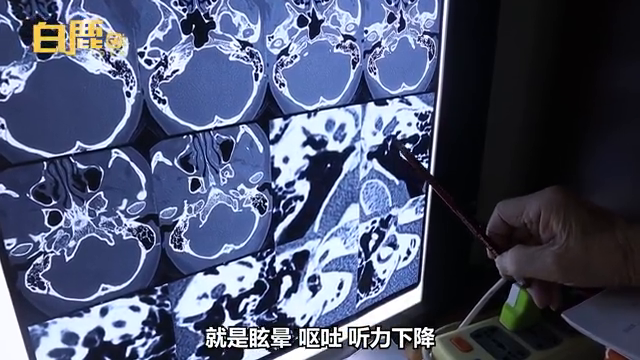 4岁儿子给妈妈掏耳朵致其眩晕一个月