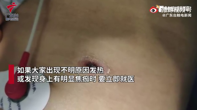 爱猫的你要警惕！女子撸猫后患恙虫病呼吸衰竭