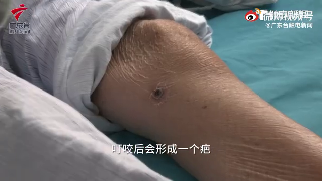 爱猫的你要警惕！女子撸猫后患恙虫病呼吸衰竭